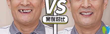 泉州牙博士好不好？牙博士單顆牙缺失即刻種植案例來證明
