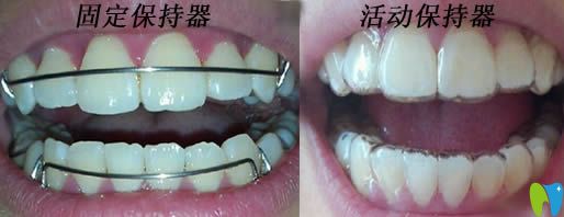 固定保持器和活動保持器圖