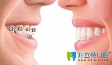 牙齒矯正后會(huì)反彈嗎?分享做牙齒矯正反彈的預(yù)防及補(bǔ)救方法