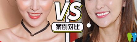 牙博士口腔泉州補牙哪家好？來看牙博士口腔補牙治療前后對比案例