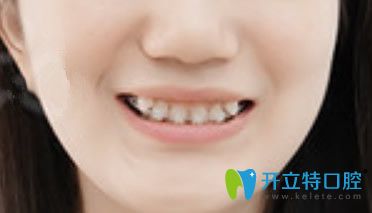 去泉州牙博士口腔做虎牙+深覆頜矯正1個(gè)月 去泉州牙博士口腔做虎牙+深覆頜矯正1個(gè)月