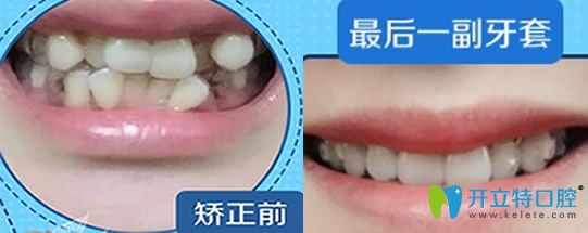 屬于泉州牙博士口腔牙齒過度擁擠不齊矯正案例對(duì)比圖