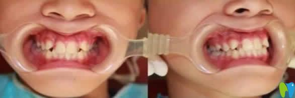 公布我15歲的兒子在無錫金貝齊齒科做虎牙矯正前后對(duì)比照片