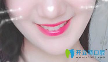 泉州牙博士口腔牙齒矯正效果圖一覽 泉州牙博士口腔牙齒矯正效果圖一覽