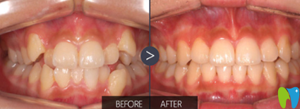 鄭州華領(lǐng)齒科矯正對(duì)比圖