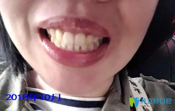 我在寧波協(xié)禾口腔做牙齒矯正第16個(gè)月效果 我在寧波協(xié)禾口腔做牙齒矯正第16個(gè)月效果