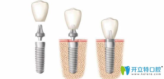 詳解什么是種植牙?關(guān)于種植牙的知識(shí)及牙齒種植價(jià)格大解析