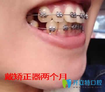 我在天津愛(ài)齒口腔做牙齒矯正兩個(gè)月照片