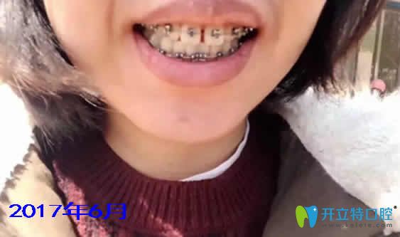 我在寧波協(xié)禾口腔做自鎖托槽矯正個(gè)月 我在寧波協(xié)禾口腔做自鎖托槽矯正個(gè)月