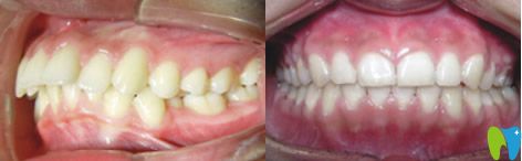 漢中小白象口腔真實(shí)牙齒矯正案例