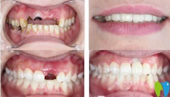 南京江寧藍(lán)鱘口腔姚云俊種植牙效果圖 南京江寧藍(lán)鱘口腔姚云俊種植牙效果圖