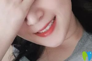 萌芽齒科牙套919天矯正完成摘到牙套后圖片 萌芽齒科牙套919天矯正完成摘到牙套后圖片