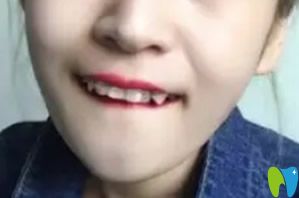 武漢萌芽齒科戴牙套第1天圖 武漢萌芽齒科戴牙套第1天圖