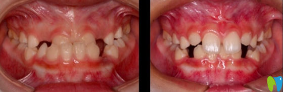 9歲的小朋友骨性反合矯正案例