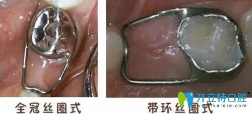 開(kāi)立特口腔乳牙間隙保持器圖片