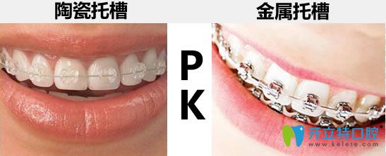詳解陶瓷托槽矯正和金屬托槽的區(qū)別 想知道牙套價格看這里