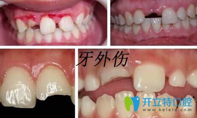 口腔知識:牙外傷處理原則以及兒童牙齒外傷脫位的應急處理