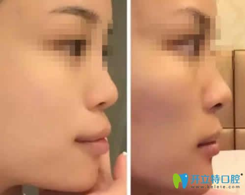 看妹子在南昌輝煌口腔做隱形齙牙矯正前后臉型對比照片 