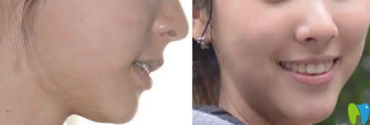 我在?？趪趴谇蛔鲭[形牙齒矯正2年后照片