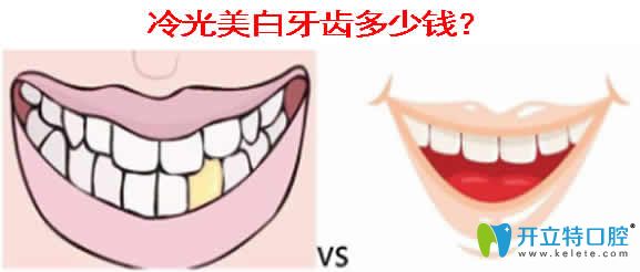 冷光美白牙齒多少錢