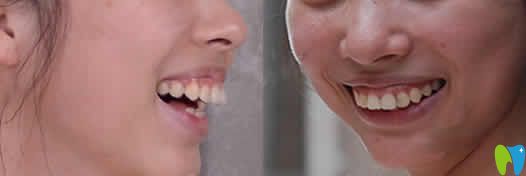 我在海口國雅口腔做隱形牙齒矯正前后照片及親身經(jīng)歷分享