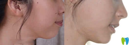 我在?？趪趴谇蛔鲅例X矯正前后對比照片