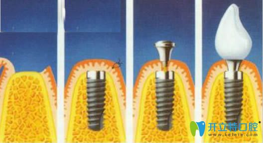 種植牙過程分為幾個步驟