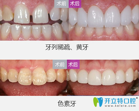 魏東牙貼面修復(fù)牙齒案例前后效果對(duì)比圖