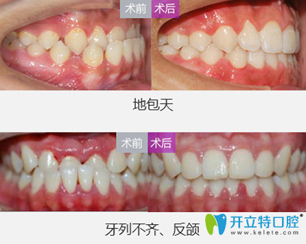 美萊口腔院長地包天矯正+牙列不齊、反頜矯正案例