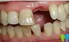 種植牙不好嗎？談談我爸在武漢華美口腔種植牙感受