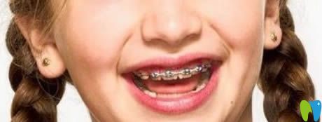 <!--<i data=20240703-sp></i>-->南醫(yī)生解析兒童牙齒矯正的年齡