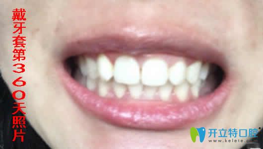 我在合肥世佳口腔做牙齒矯正一年的照片