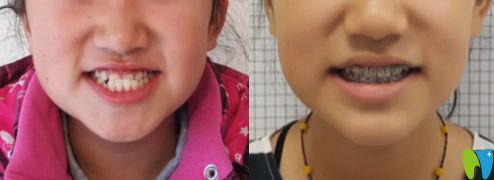 周瑾帆替牙期小孩地包天矯正案例前后效果對比圖