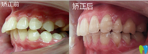 桂林瑾帆口腔好不好？真人牙齒矯正案例及術(shù)后反饋來驗證