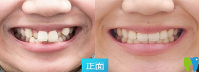 武漢斯美爾口腔舌側(cè)隱形矯正效果圖 武漢斯美爾口腔舌側(cè)隱形矯正效果圖