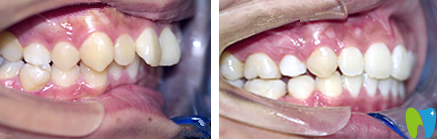 斯美爾口腔隱形矯正前后對(duì)比圖 斯美爾口腔隱形矯正前后對(duì)比圖