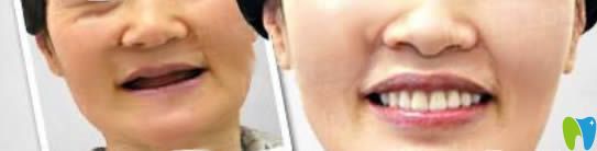 中山維爾口腔60歲老人全口種植牙案例對(duì)比圖 中山維爾口腔60歲老人全口種植牙案例對(duì)比圖