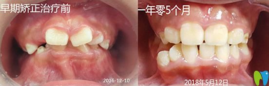 想了解孩子牙齒矯正時(shí)間 看桂林瑾帆口腔兒童正畸案例