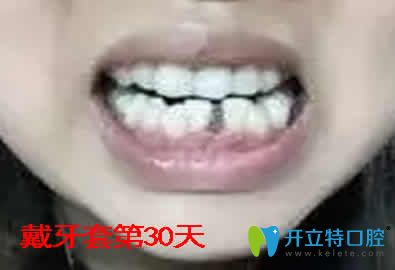 我在重慶嘉悅口腔做隱形矯正第30天照片