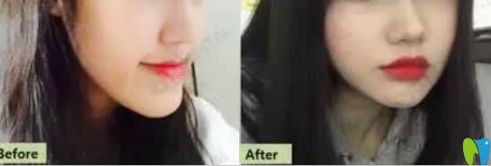 齙牙矯正案例效果及前后對(duì)比照 齙牙矯正案例效果及前后對(duì)比照