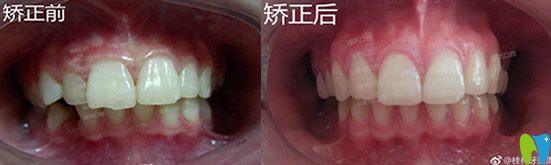 屬于桂林瑾帆口腔孩子齙牙矯正案例