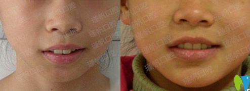 瑾帆口腔周瑾帆小孩門牙前突矯正案例