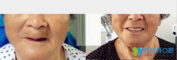 中山維爾口腔All-on-4全口種植牙真實(shí)案例 中山維爾口腔All-on-4全口種植牙真實(shí)案例