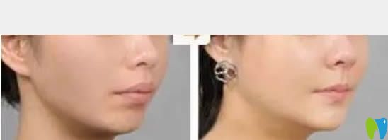 中山維爾口腔齙牙矯正后臉型對(duì)比圖 中山維爾口腔齙牙矯正后臉型對(duì)比圖