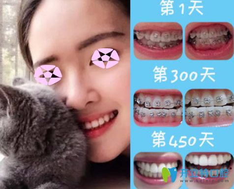 成人矯正牙齒效果好嗎？看上海伊爾意口腔正畸前后對(duì)比圖