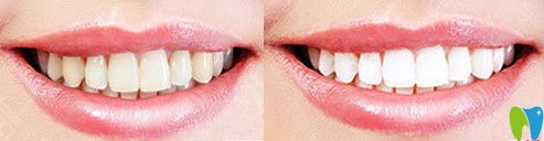 優(yōu)植口腔冷光美白牙齒對(duì)比圖