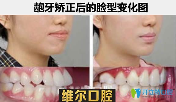 齙牙矯正后臉型對比案例 齙牙矯正后臉型對比案例