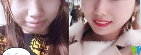 伊爾意口腔齙牙矯正案例前后效果對(duì)比