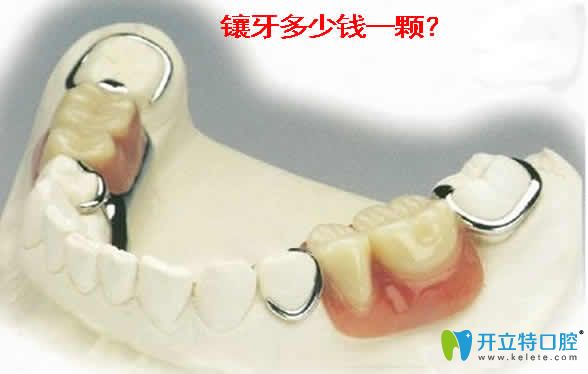 鑲牙多少錢一顆