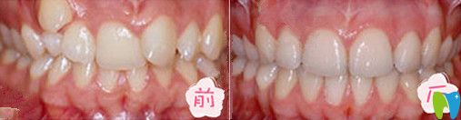 我在長(zhǎng)沙優(yōu)植口腔矯正療效圖